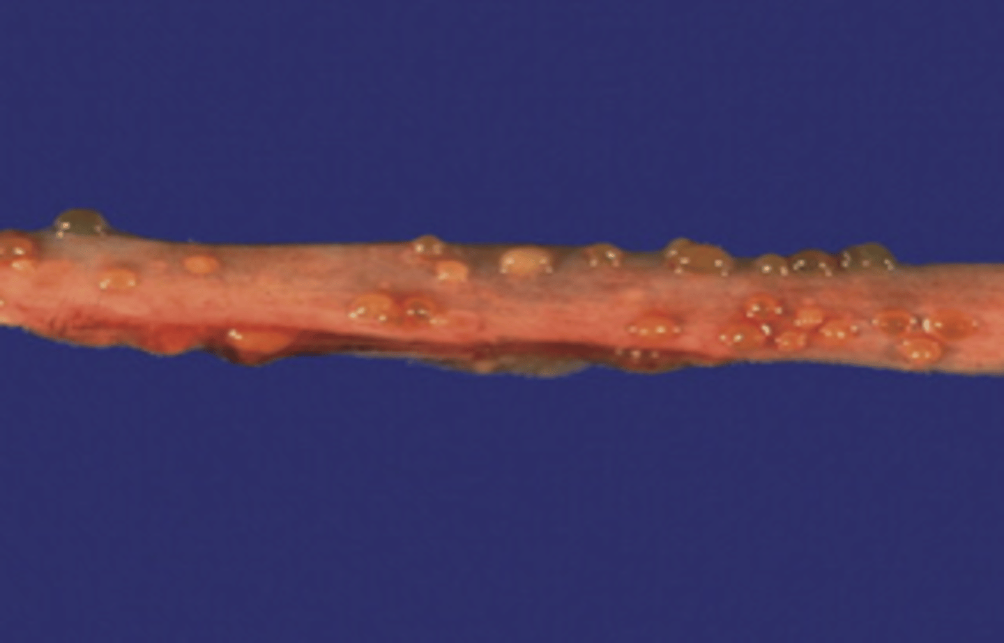 <p>inflammation of a ureter</p>