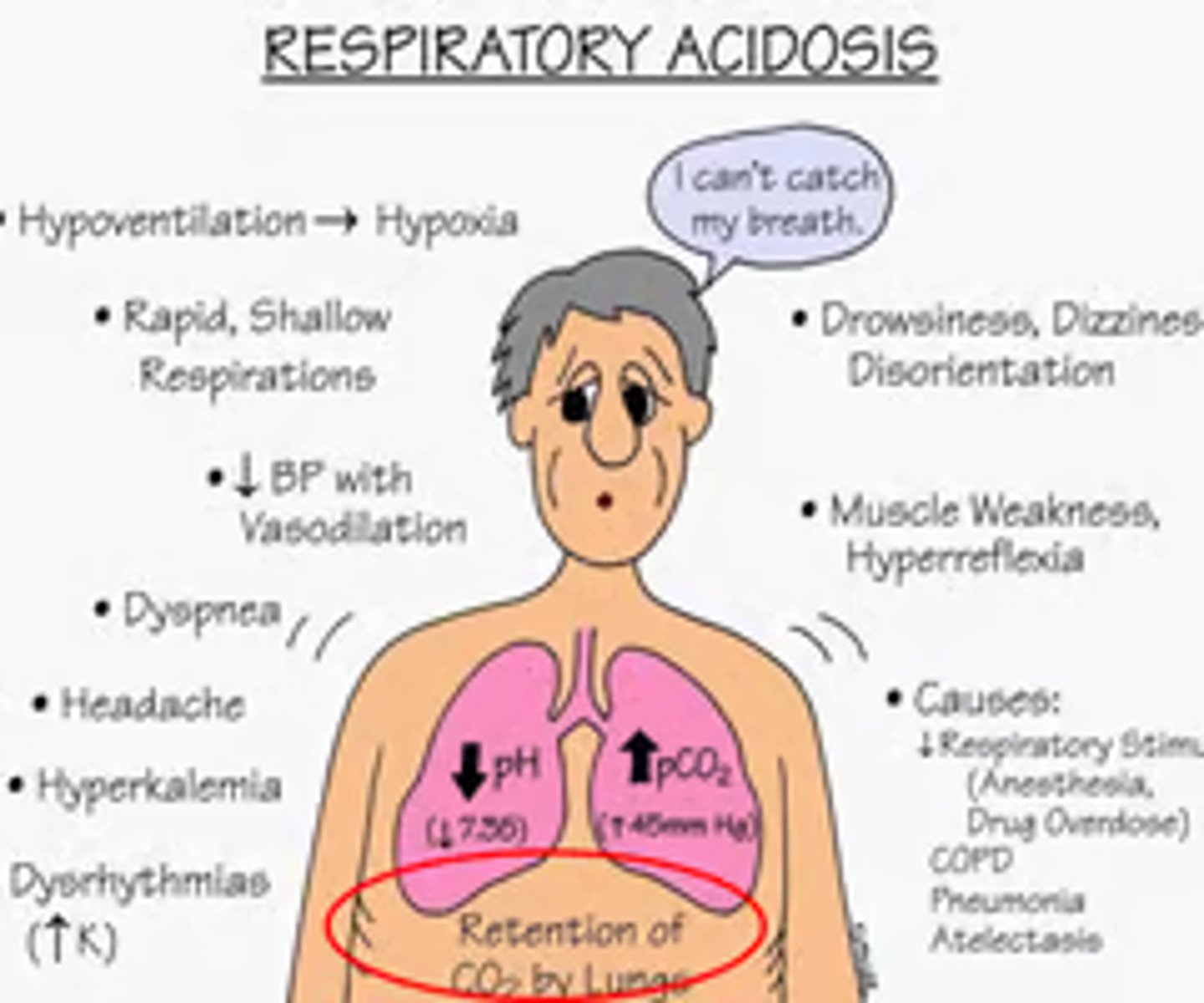 <p>- D: Drugs (opiates, sedatives) diseases of neuromuscular system</p><p>- E: Edema</p><p>- P: Pneumonia</p><p>- R: Respiratory center in brain (brain injury)</p><p>- E: Emboli</p><p>- S: Spasms of bronchial tubes d/t asthma</p><p>- S: Sac (alveolar) elasticity d/COPD</p>