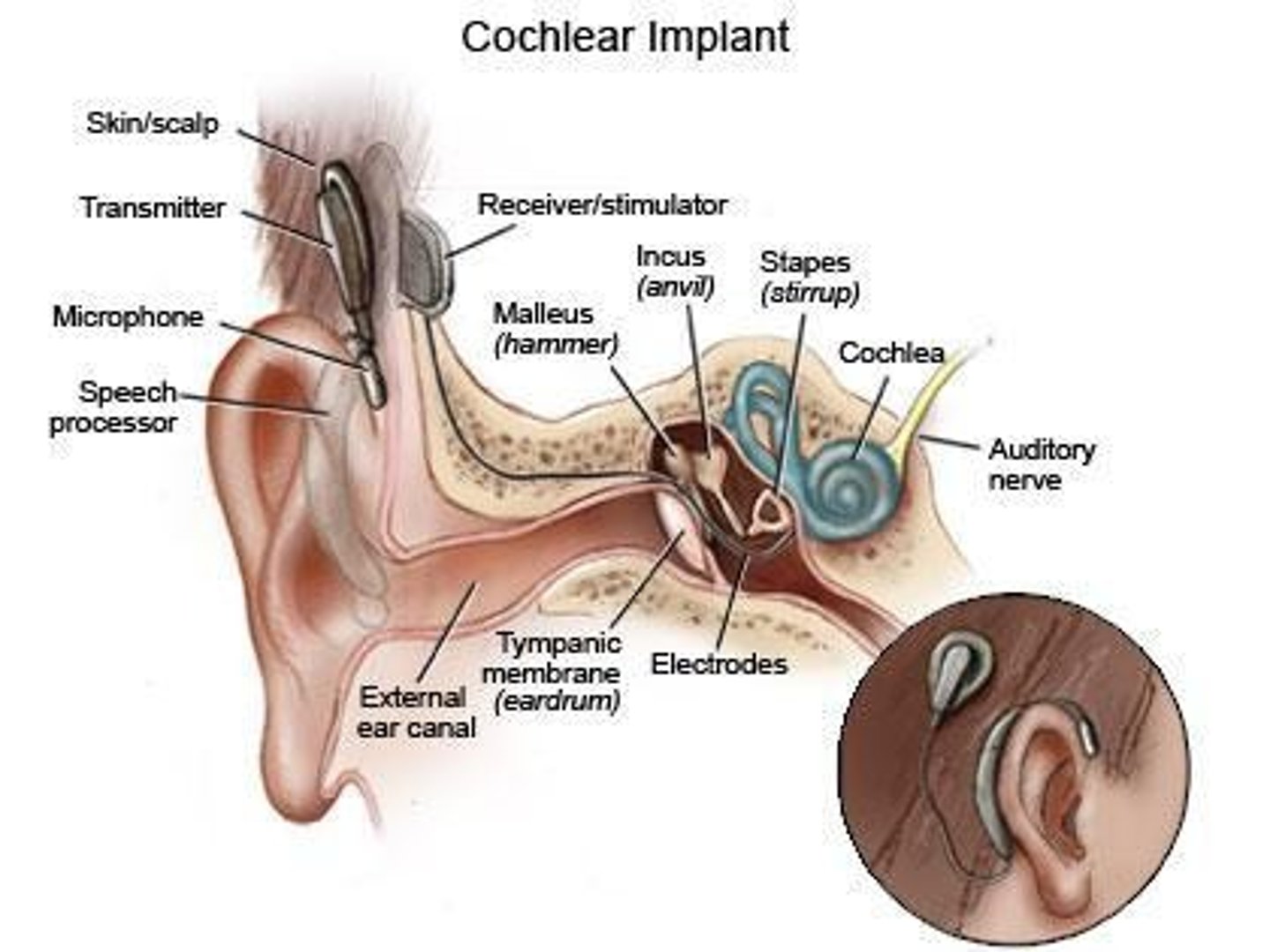 <p>Devices improving hearing through direct auditory stimulation.</p>