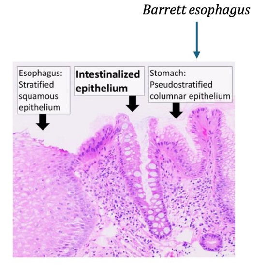 <p>esophagus normally lined by squamous epithelium (suited to handle friction of food bolus)</p><p>new stressor: acid reflux from stomach causes metaplasia</p><p>new cell type becomes mucin-producing columnar cells (better able to handle stress of acid)</p>