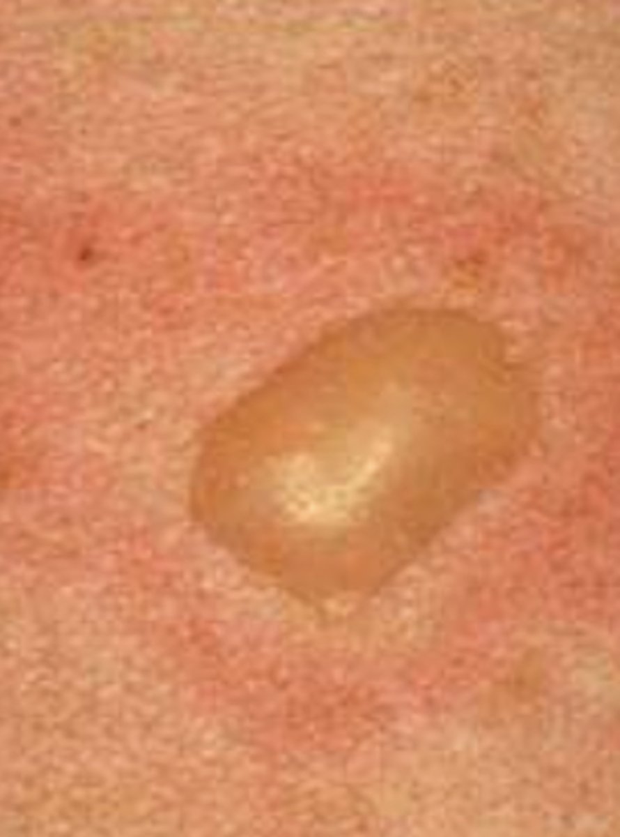 <p>¿lesión?</p><p>¿primaria o secundaria?</p>