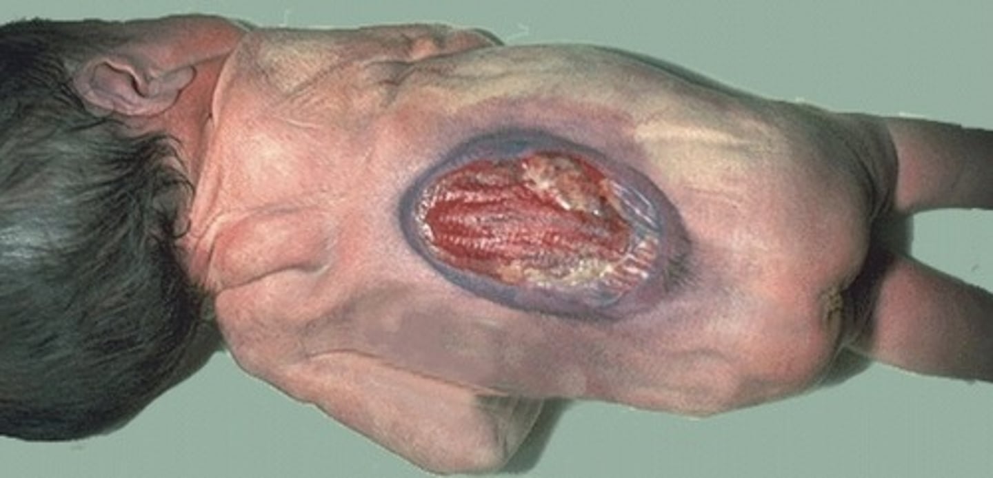 <p>No vertebral arches</p><p>Exposed meninges or spinal cord</p>