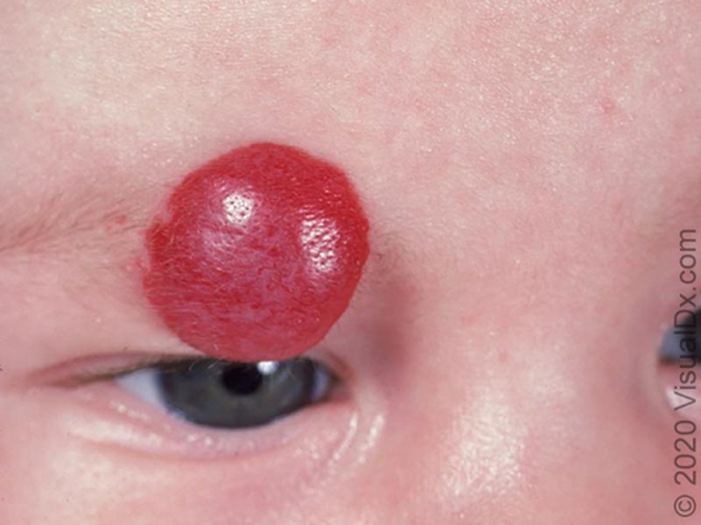 <p>Infantile hemangiomas (IН) are benign tumors of vascular endothelium and the most common tumors of ϲhilԁhoοԁ [1]. Despite their benign and self-limited nature, some hemangiomas can cause complications, such as ulceration or life-altering disfigurement. Occasionally, hemangiomas may compromise vital organ function or may occur in association with developmental anomalies.</p><p>Depending on placement and number of them they should be further evaluated</p><p>will dissolve around 2 yrs of age</p>