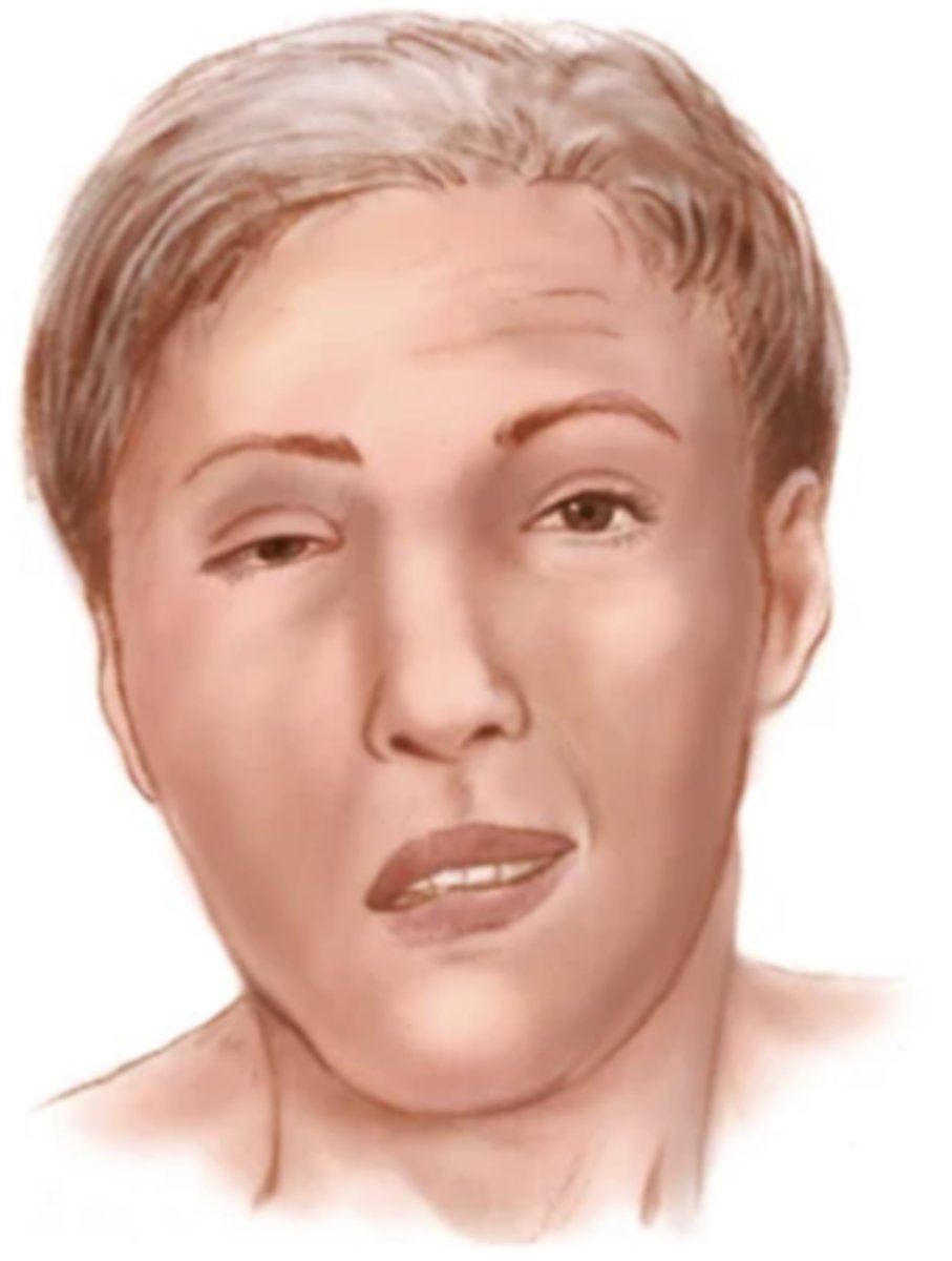 <p>Muscle weakness (paresis) or loss of power - hemi/para/quadriplegia</p>