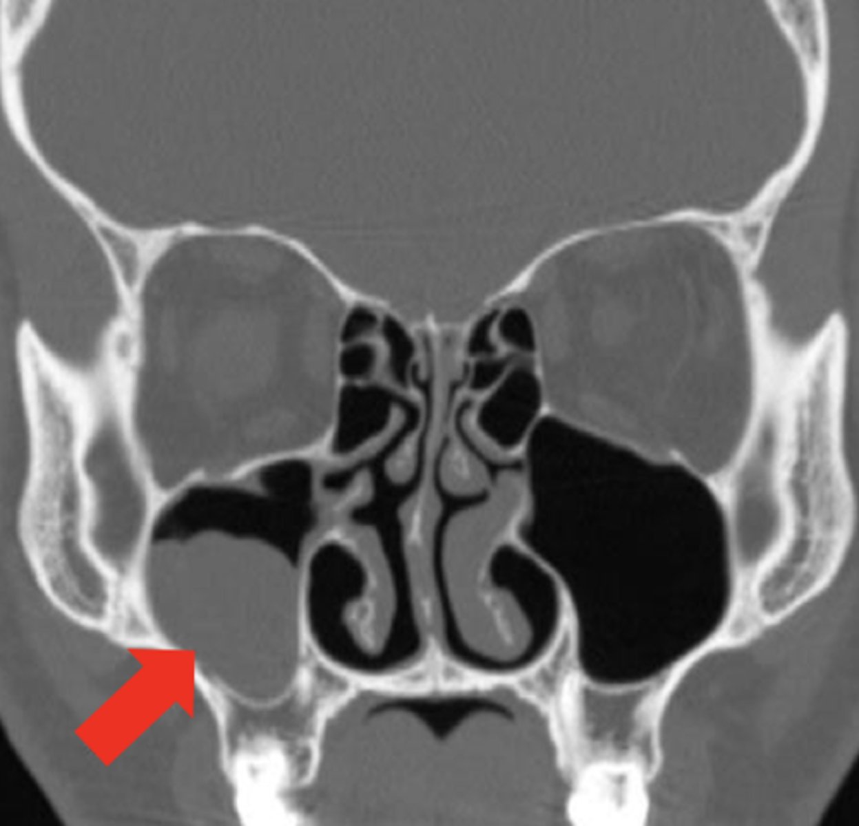 <p>most common of all the sinuses to be infected, infection can spread from sinus to upper teeth...s/s of sinus infection plus tooth pain (because the V2 branch also innervates teeth via superior alveolar nerve)</p>