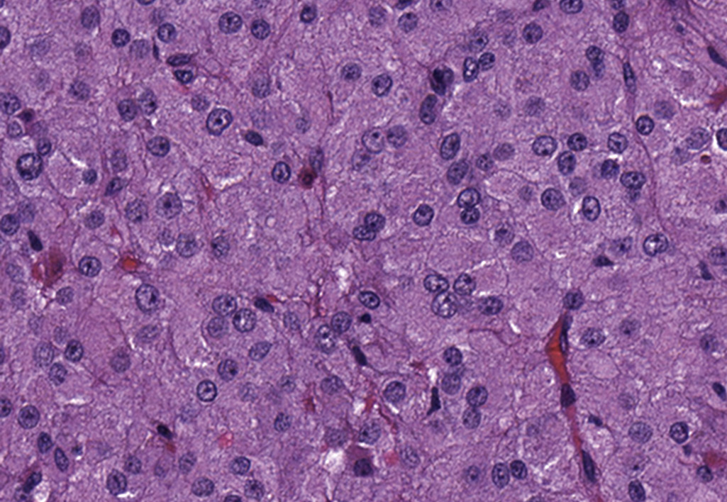 <p>A 37-year-old man has noticed bilateral breast enlargement over the past 6 months. On physical examination, both breasts are enlarged without masses. His right testis is firm and 1.5 times larger than his left testis. His serum estrogen is increased. An ultrasound scan shows a circumscribed 2-cm mass in the body of the right testis. A right orchiectomy is performed, and grossly the mass has a uniform, brown cut surface. The microscopic appearance is shown in the figure. With electron microscopy the cells have rod-shaped crystalloids of Reinke. What is the most likely diagnosis?</p><p></p>