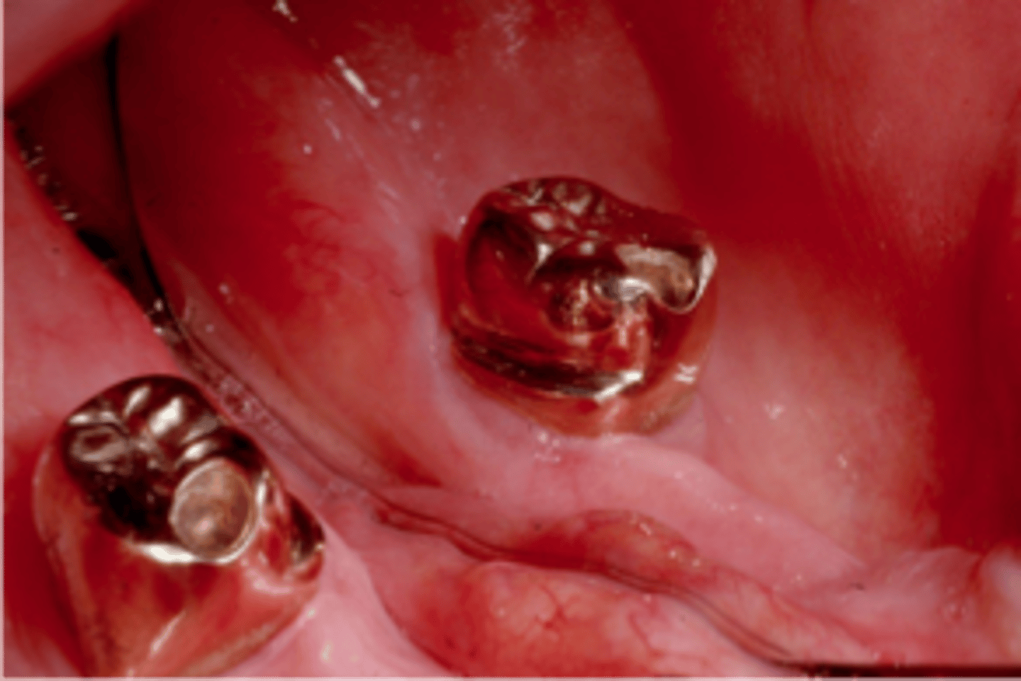 <p>This gold crown serves as an RPD abutment. The milled lingual ledge optimizes reciprocation and allows the bracing arm to restore normal lingual contour when the RPD is fully seated. The bracing arm would be less noticeable to the patient.</p>