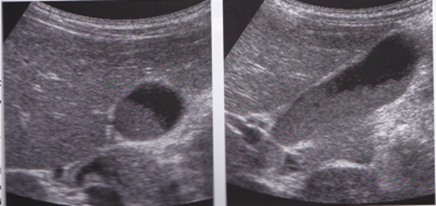 <p>- thickened/viscid bile that occurs from bile stasis</p>