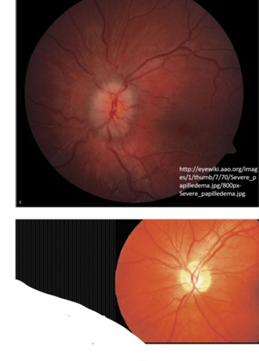 <p>papilledema = edema sup and inf, muddy peripapillary reflex</p><p>drusen = focal atrophy, normal linear light reflexes</p>