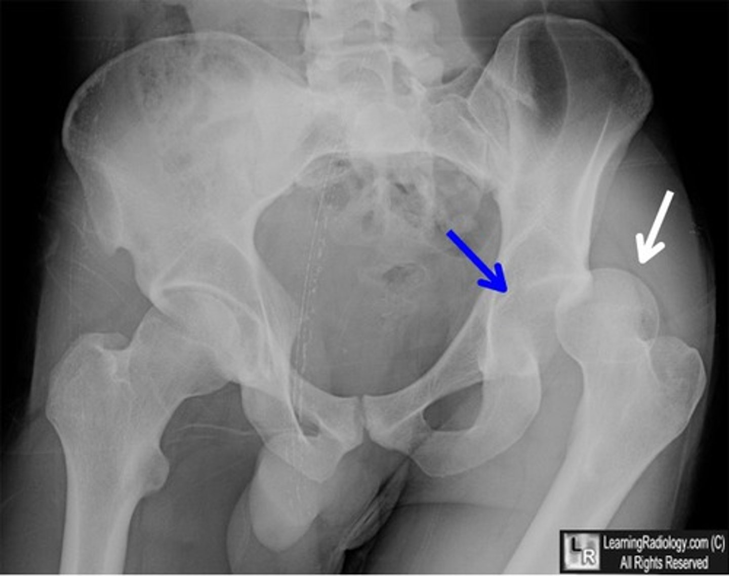 <p>Posterior dislocation is the most common (90%)</p><p>risk of vascular damage and nerve injury</p><p>weak hip flexion, knee extension, ankle dorsiflexion (common perineal nerve)</p><p>can lead to avascular necrosis/osteoarthritis</p>
