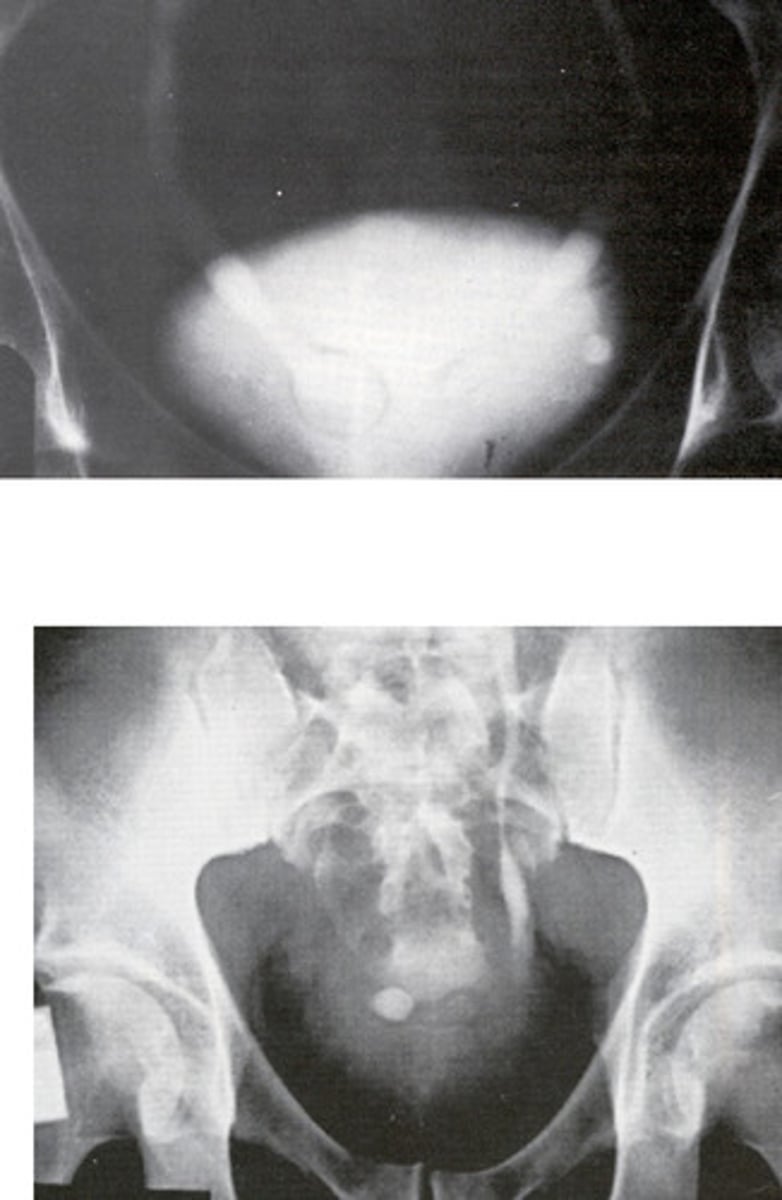 <p>- What congenital anomaly refers to the cyst-like dilation of the distal ureter where it enters the trigone of the bladder?</p><p>- How does this pathology appear radiographically when the bladder is contrast-filled?</p><p>- How is this pathology treated?</p>