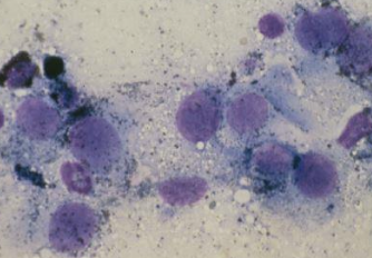 <p>Melanoma will have dark gray/black/purple pigment granules,</p><p>MCT granules are more red/pink and often have eosinophils around </p>