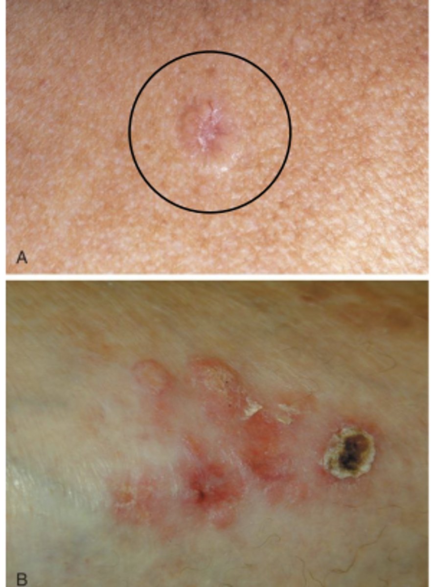 <p>slow growing skin tumor from undifferentiated epidermis basal cells</p><p>- Can cause local destruction</p><p>- Slightly elevated, pearly or ivory color, rolled edges, visible blood vessels</p><p>- "Sore that will not heal"</p>