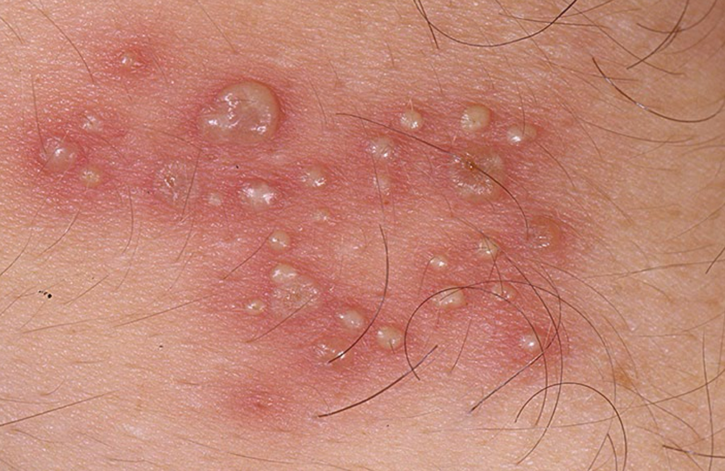 <p>describe the lesion; what condition</p>