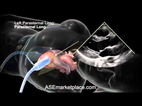 <p>The transducer is placed to the left side of the sternum in the 2nd to 3rd intercostal space, with the index directed toward the patient's right shoulder.</p>