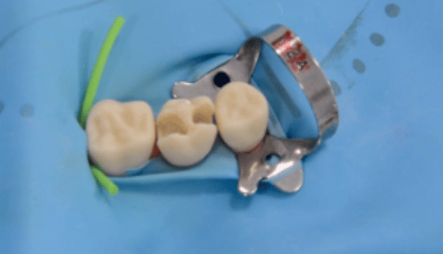 <p>• Isolate w/ a rubber dam &amp; prepare LR6d cavity as indicated (small &lt;1mm pulpal exposure)</p><p>• Carefully approach the floor &amp; axial wall where a pulpal exposure might be anticipated</p><p>• Pin prick exposure only, consider pulpal position, 5 mm from the occlusal surface or &gt;3 mm from DEJ: 'pulpal blush', stop</p>