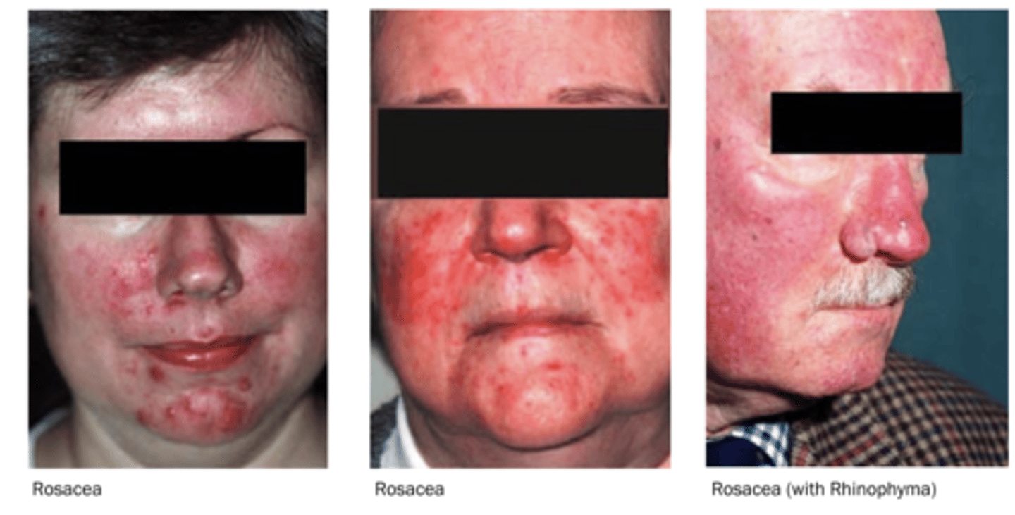 <p>• Flushing often made worse by alcohol, spicy foods, hot drinks, temperature changes or emotion </p><p>• Telangiectasia </p><p>• Papules on erythematous background </p><p>• Pustules </p><p>• Facial disfigurement</p><p>• Intermittent or permanent </p><p>• Rhinophyma</p><p>SUNLIGHT can exacerbate it</p>
