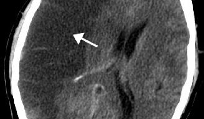 <p>Which stroke has the following appearance on a head CT?</p><ul><li><p>dark; may be normal w/in first 24 hours</p></li></ul><p></p>