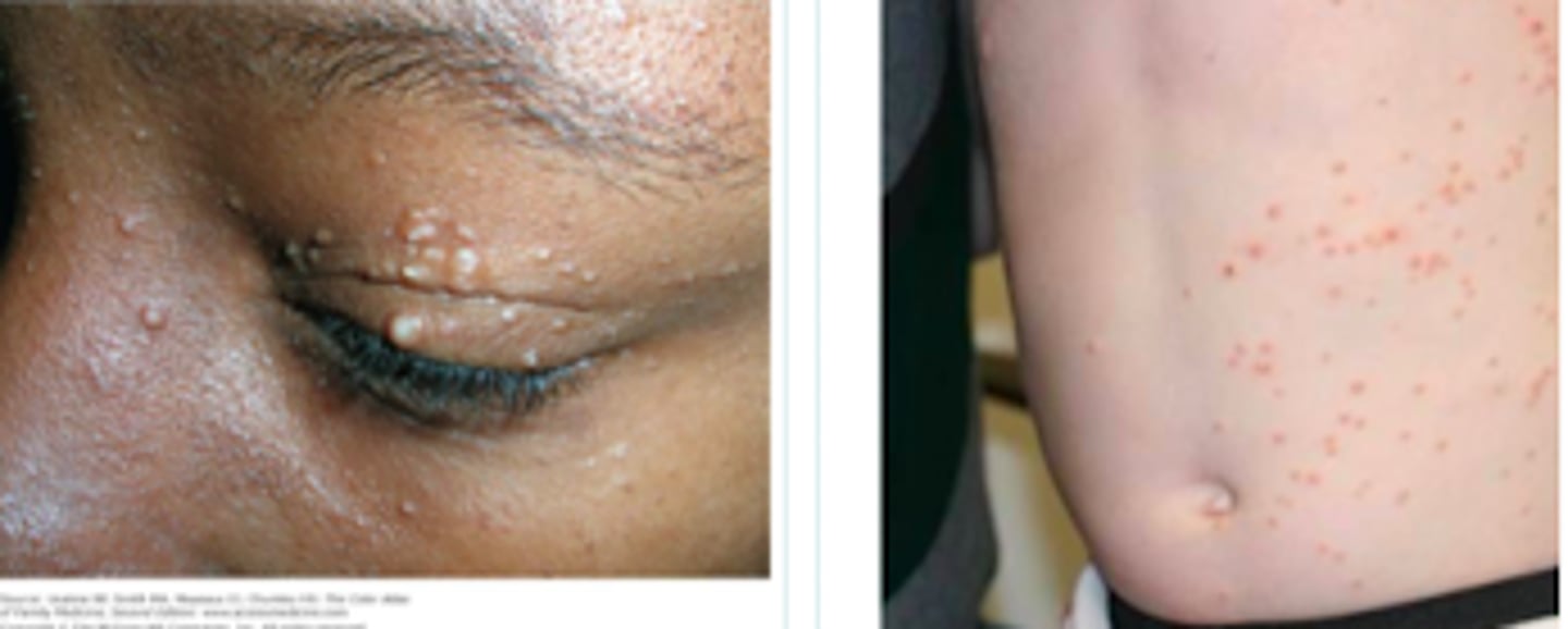 <p>Viral Skin Infections:</p><p>- self-limited epidermal viral infection</p><p>-<strong> skin-to-skin</strong> contact</p><p>-<strong> asymptomatic,</strong> but (mostly parents) concerned about <strong>cosmetic disfiguremen</strong>t, <strong>painful if infected</strong></p><p>- presents as pearly white or skin-colored papules or nodules, <strong>round and umbilicated</strong></p>