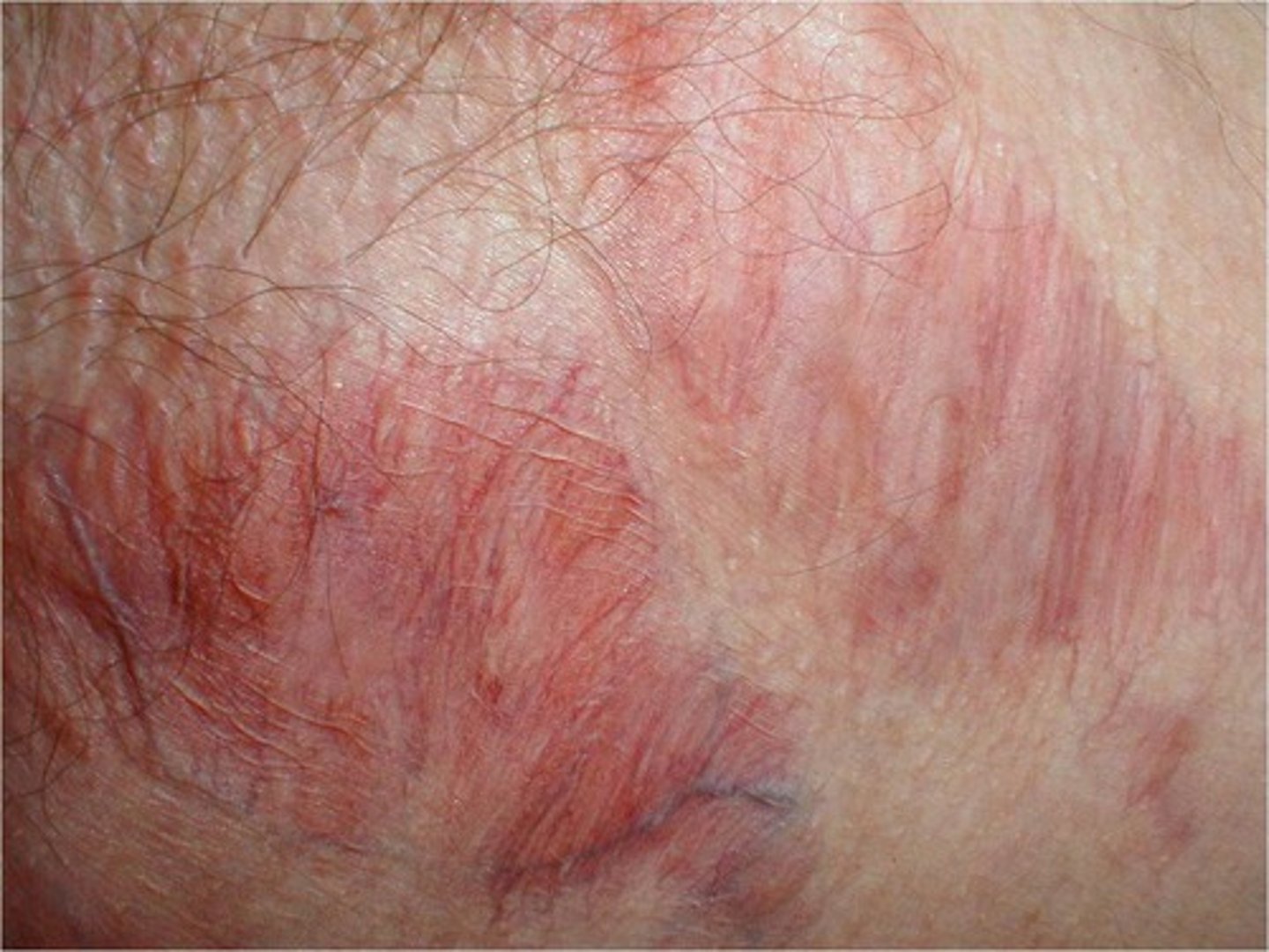 <p>thinning of the skin surface and loss of skin markings, skin appears translucent and paper like</p>