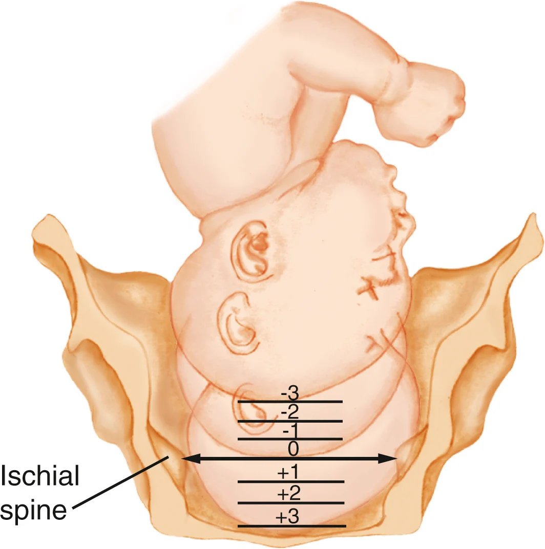 <p>describes the descent of the fetal presenting part in relation to the level of the ischial spines</p><ul><li><p>the level of the ischial spines is zero station</p></li><li><p>as the fetus descends it will go from high negatives numbers (-3, -2, -1) to zero to high positive numbers (+1, +2, +3)</p></li></ul>