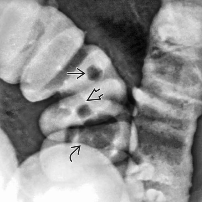 <p>What pathology is shown here?</p>
