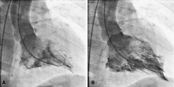 <p>what cardiomyopathy</p>