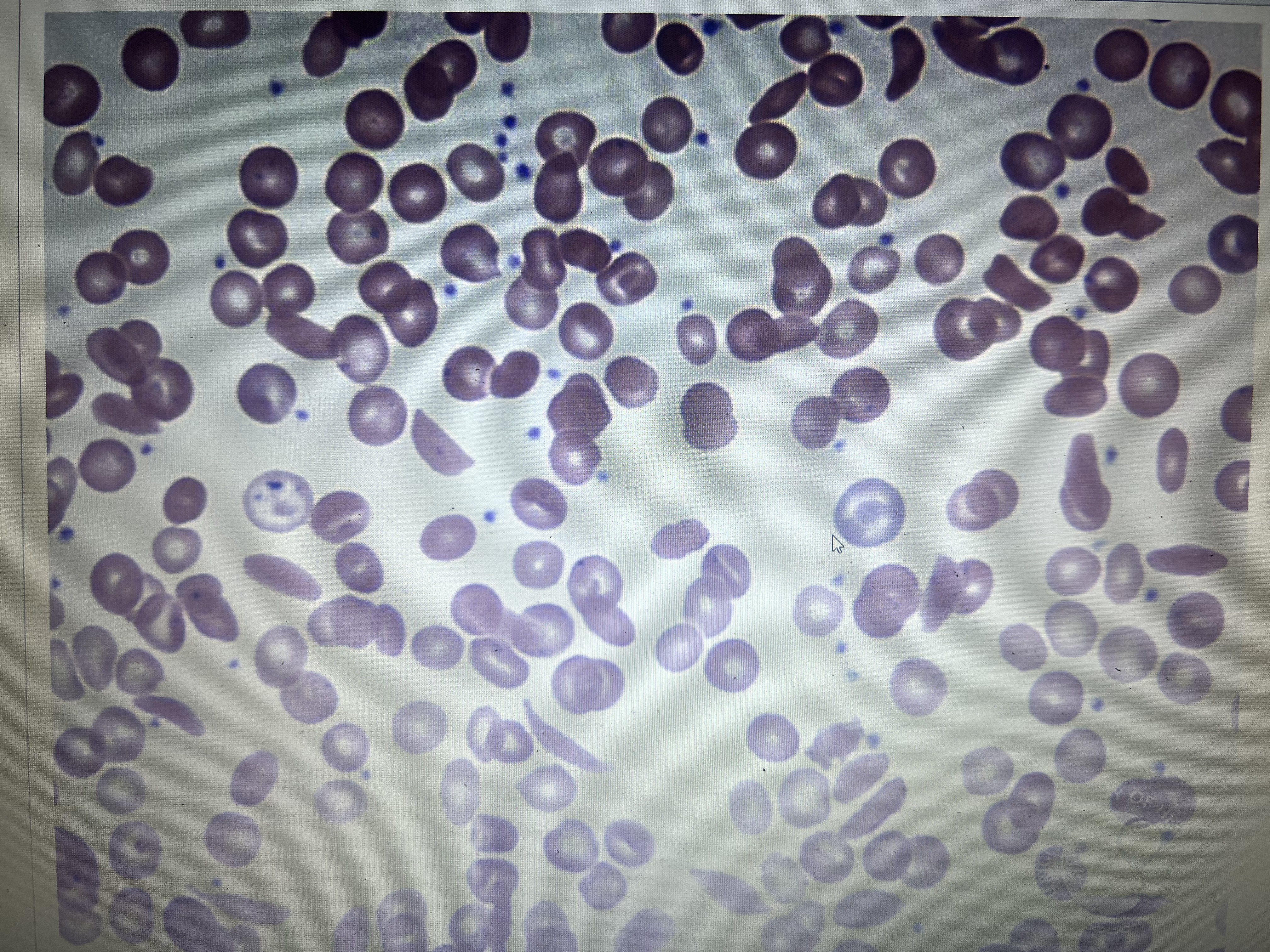 <p>the cells seen below in the wright’s stained peripheral blood smear are diagnostic of which condition </p>