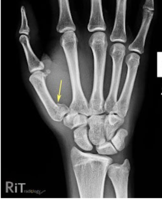 <p>What fracture is this?</p>