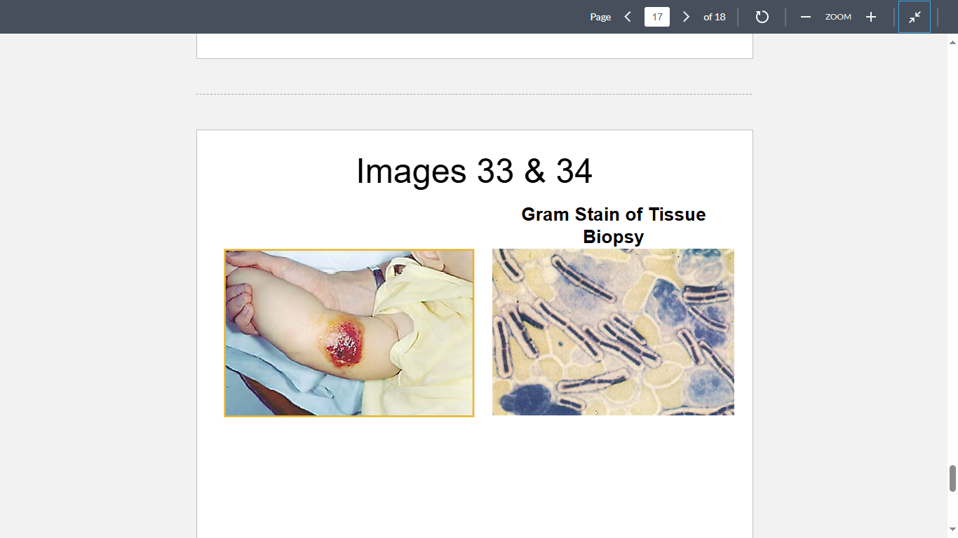 <p>A 7-month-old boy was admitted to the PICU with elevated white blood count, was afebrile, and had a 2-cm open sore with surrounding erythema and induration that oozed 5 clear yellow fluid (Image 33). There was swelling and erythema of the entire arm. Upon questioning, the patient’s family recounted that the child had recently spent time at a wool sorting facility where his father was employed. Clinical biopsy of the infected site revealed the following organisms (Image 34). What organism is the most likely cause?</p>