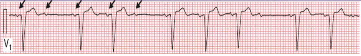 <p><span>AV block with WIDE QRS, stable PR, abruptly dropped QRS</span></p>