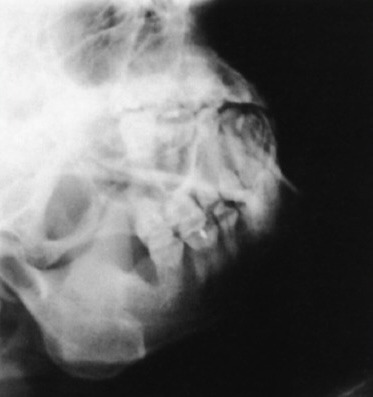 <p>What is this x-ray demonstrating?</p>