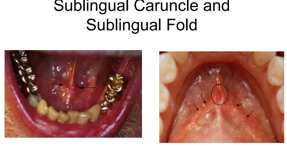 <p>Sublingual salivary gland system = 8-30 minor sublingual ducts opening independently into the oral cavity at the sublingual fold. </p><p><strong>Bartholin’s duct = </strong>formed by several of the small sublingual ducts; opens into oral cavity at the sublingual caruncles </p><p></p>