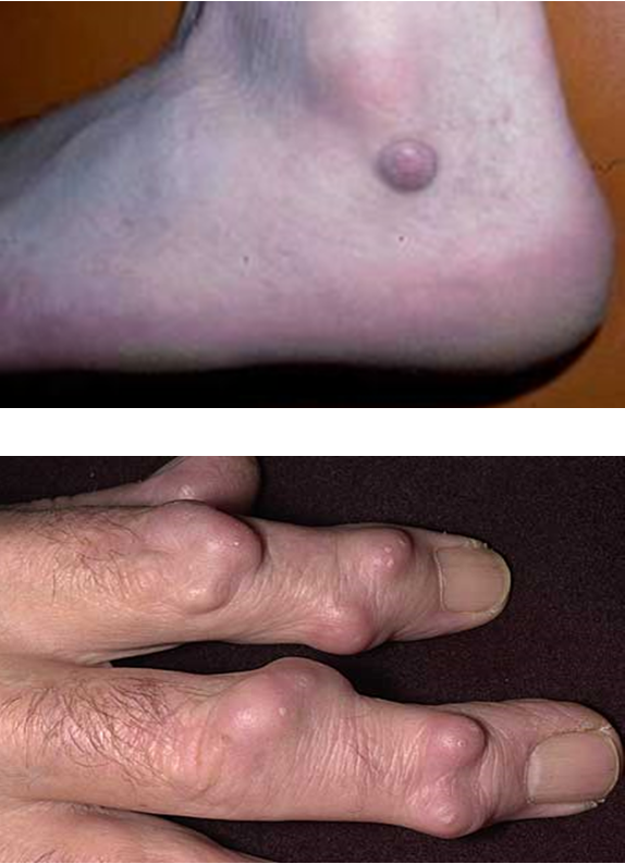 <p>solid, circular lesion greater than 1 cm that usually invades epidermis and lower dermis</p>