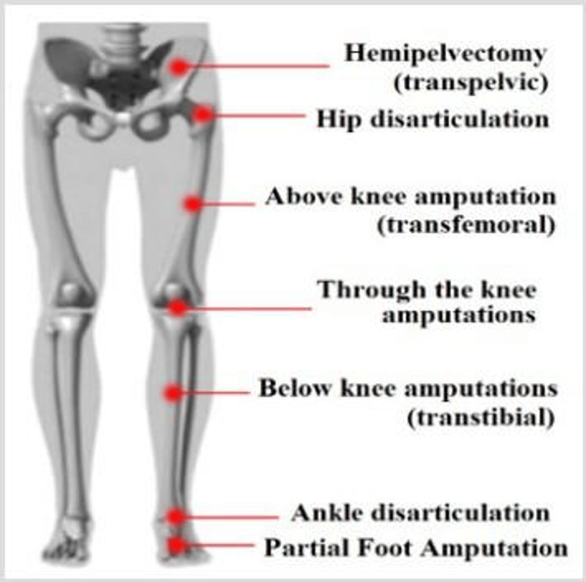 <p>To fill the space between the socket and the residual limb.</p>