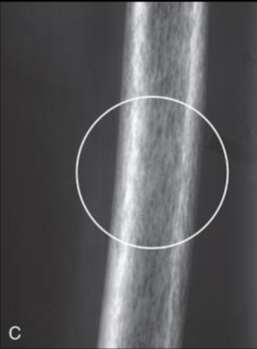 <p>Accurately describe this pattern of bone destruction</p>