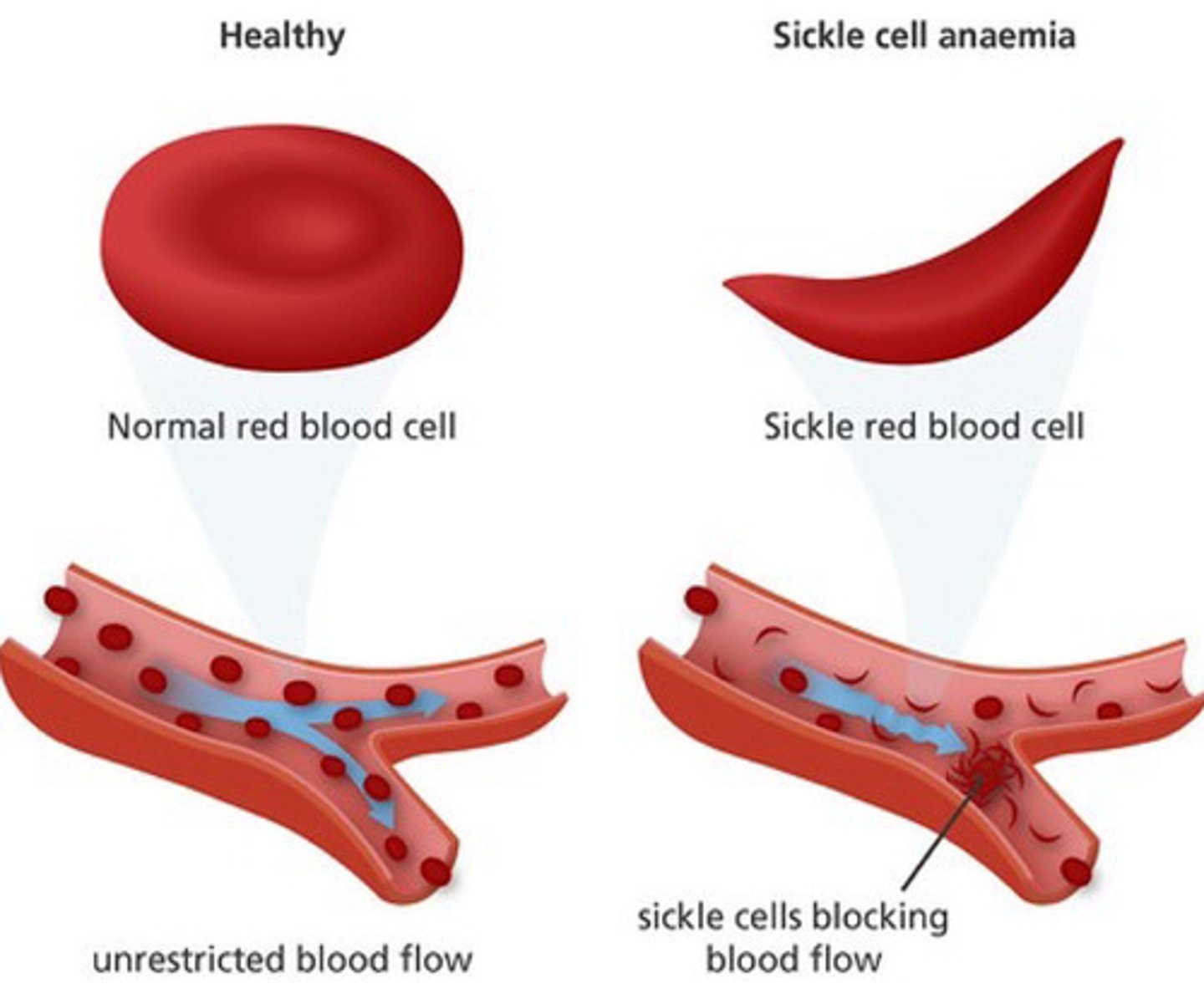 <p>- inherited, autosomal recessive disorder characterized by the presence of abnormal form of hemoglobin</p><p>- genetic mutation that leads to an alteration in RBC shape; looks like a sickle or crescent</p><p>- altered shape causes the cell to lose its ability to deform &amp; squeeze through smaller vessels &amp; affects blood flow</p>