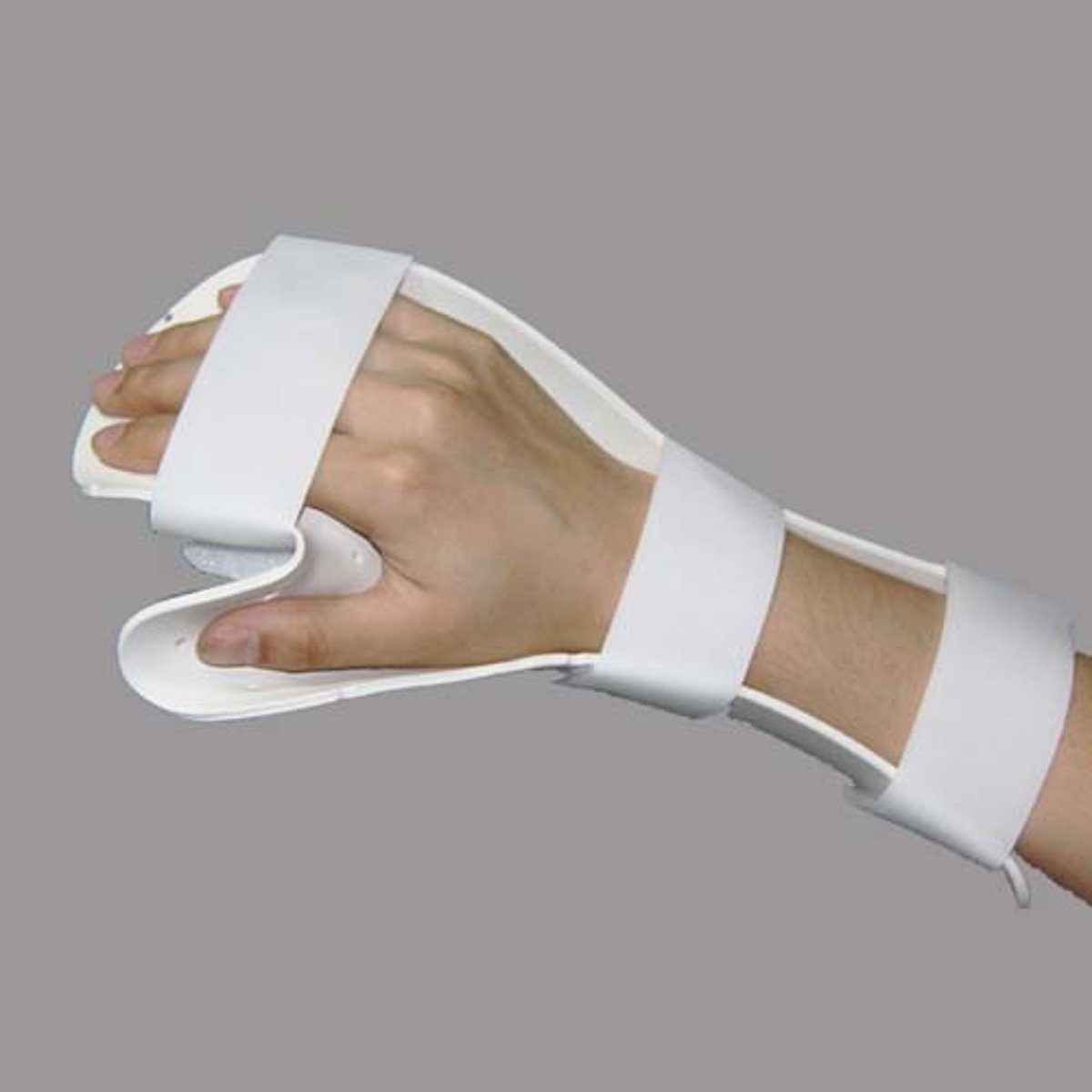 <p>- Full-length resting pan in partial wrist extension and full digit extension or slight MP flexion</p><p>- Dynamic MP extension outtrigger allowing 30 degrees of MP flexion</p><p>- Immediate active extension orthosis using wrist support and yoke or dynamic outrigger removed for active extension</p>