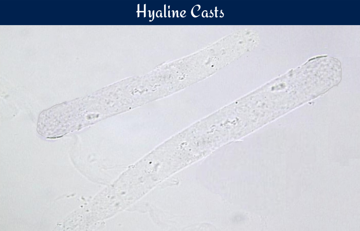 <p>hyaline/cylindroid</p>