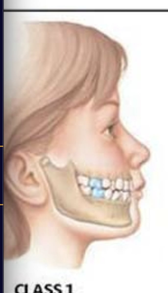 <p>Normal occlusal relation, first permanent molar of the upper jaw is positioned one-half tooth behind the first permanent molar of the lower jaw.</p>