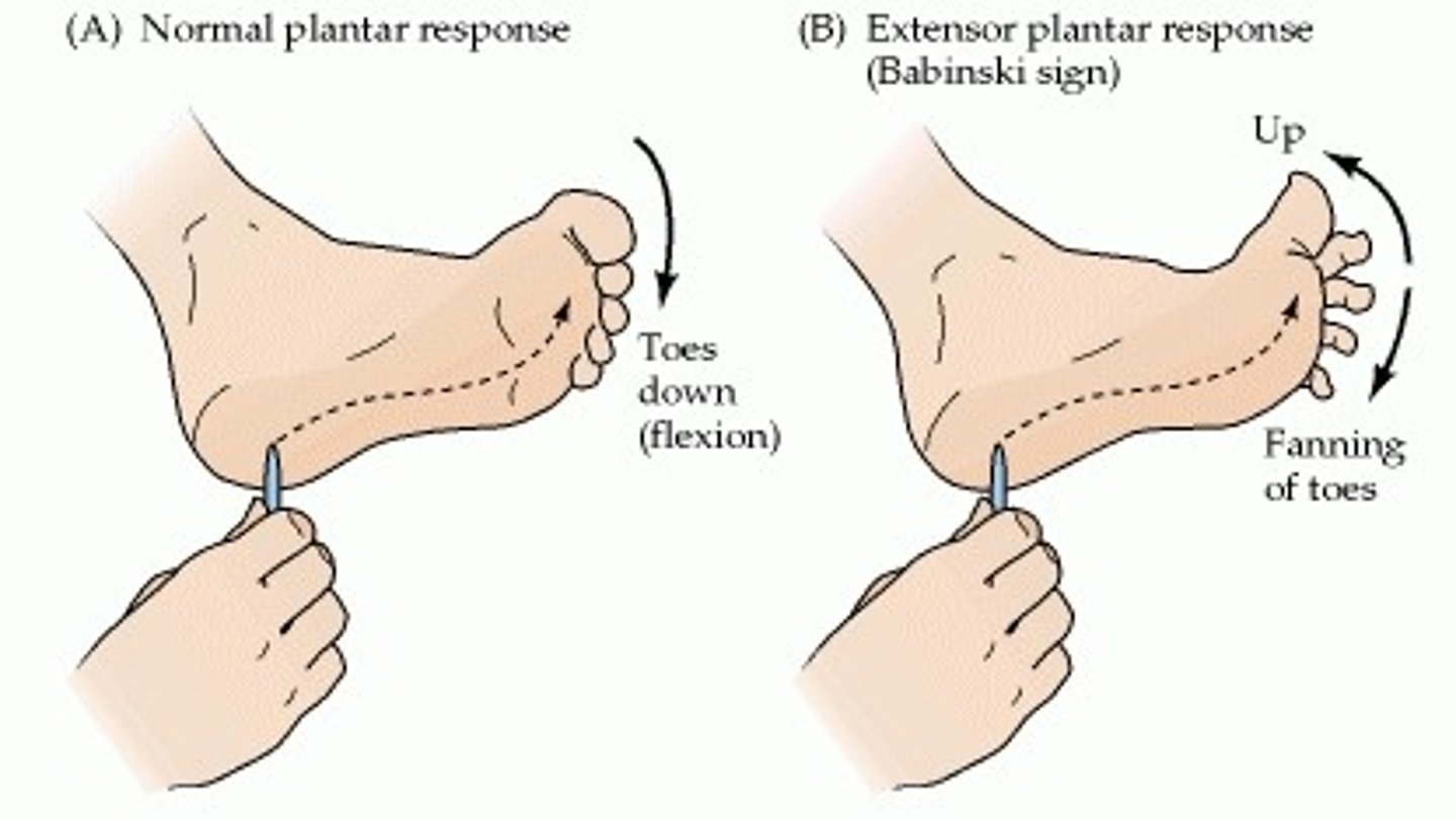 <p>firmly stroke sole of foot heel to toes, in lateral to medial curve; great toe extends and other toes splay</p>