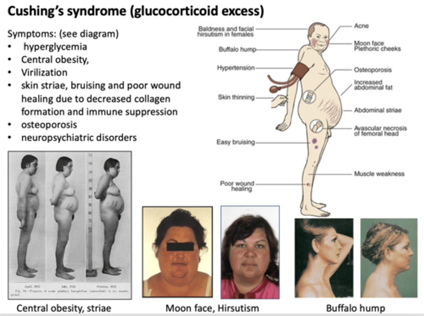 <p>Cushings syndrome</p>