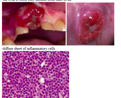 <p><span style="background-color: transparent; font-family: &quot;Times New Roman&quot;, serif;">-2<sup>nd</sup> most common malignancy in HIV+&nbsp;</span></p><p><span style="background-color: transparent; font-family: &quot;Times New Roman&quot;, serif;">-in AIDS, it is high grade and aggressive (EBV and HHV-8 detected, usually in <strong>extra-nodal sites</strong> such as CNS and oral cavity)&nbsp;</span></p><p><span style="background-color: transparent; font-family: &quot;Times New Roman&quot;, serif;">-gingiva, palate, tongue, tonsils most frequent sites&nbsp;</span></p><p><span style="background-color: transparent; font-family: &quot;Times New Roman&quot;, serif;">-survival is often only months from time of dx&nbsp;</span></p><p></p><p><span style="background-color: transparent; font-family: &quot;Times New Roman&quot;, serif;">-diffuse sheet of inflammatory cells</span></p>