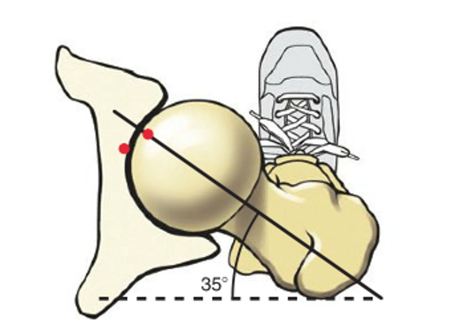 <p>1. Is this anteversion or retroversion?</p><p>2. What is the tendency seen in order to improve joint congruency?</p>