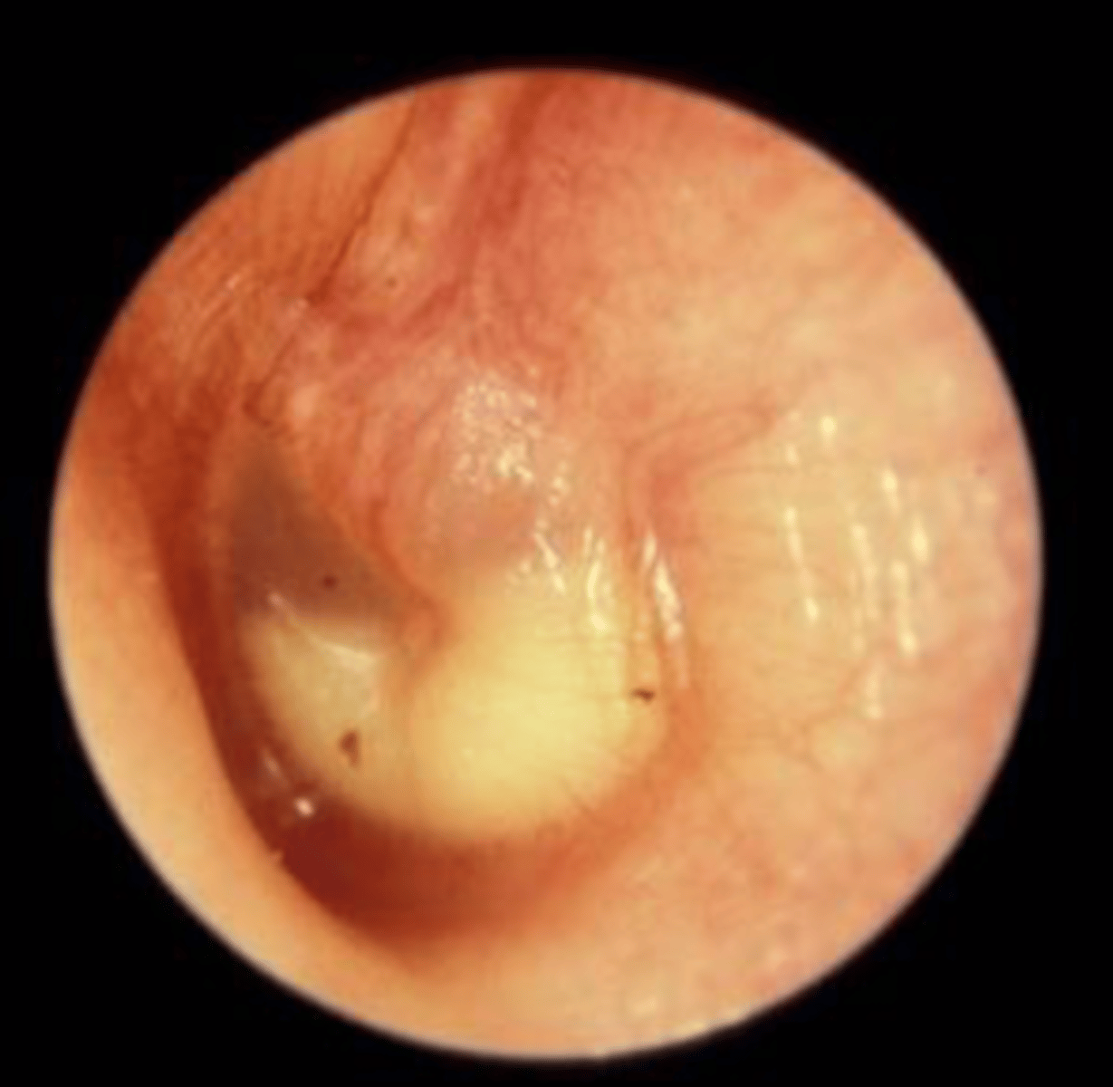 <p>Bacterial infection</p><p>After URTI</p><p>Common in children</p><p>Red, bulged TM</p><p>Possible perforation (pus)</p><p>-</p><p>Sxs:</p><p>Otalgia</p><p>Fever</p><p>Conductive HL</p>
