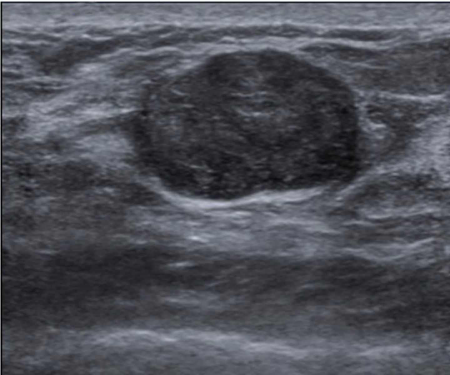 <p>U/S—Circumscribed, homogenous, oval-shaped, hyperechoic mass</p><p>Biopsy—Encapsulated, fibrous tissue</p>