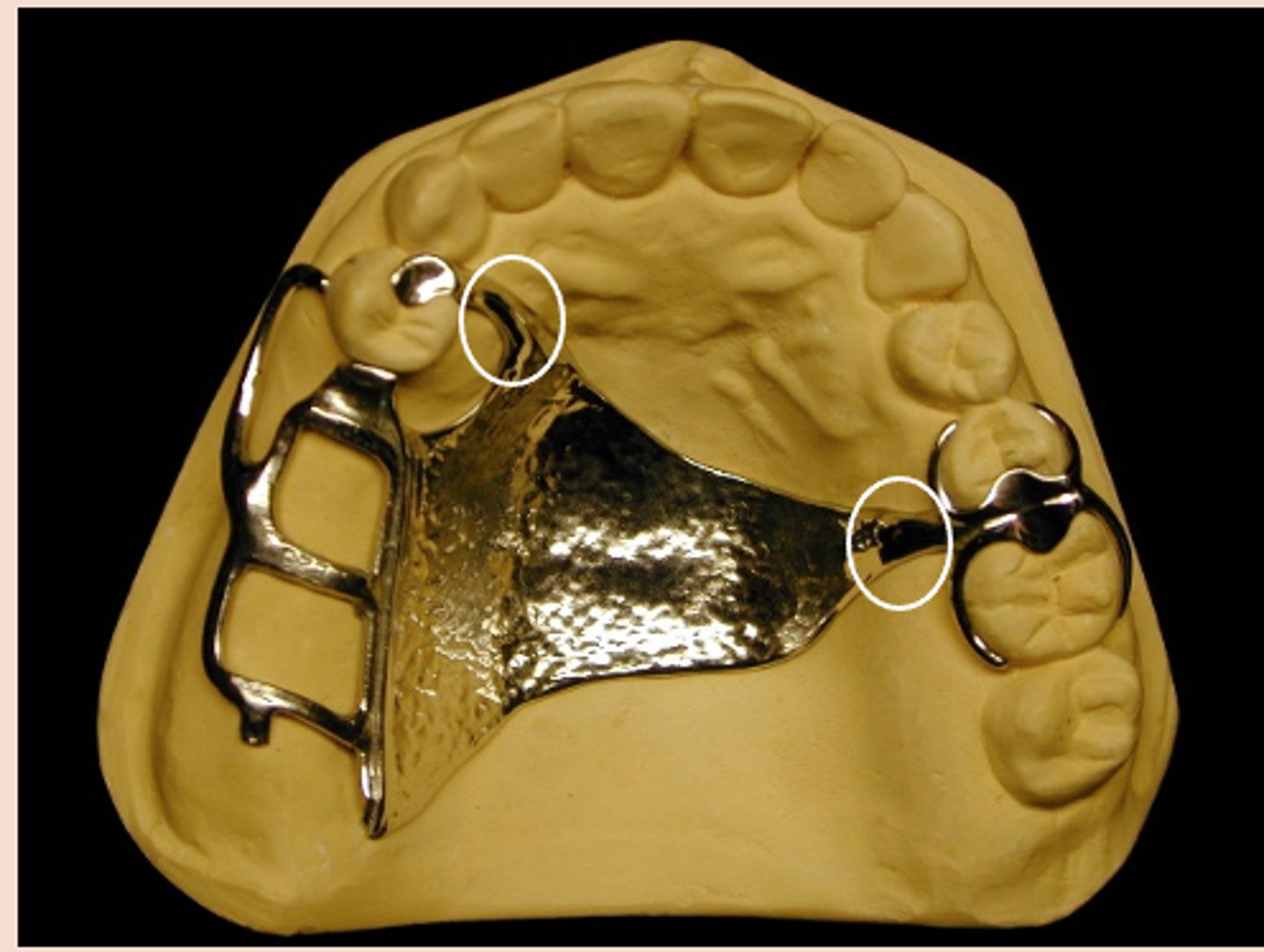 <p>Connecting link between the major connector or base of the RPD and the other units of the prosthesis, such as the clasp assembly, indirect retainers or rests</p>
