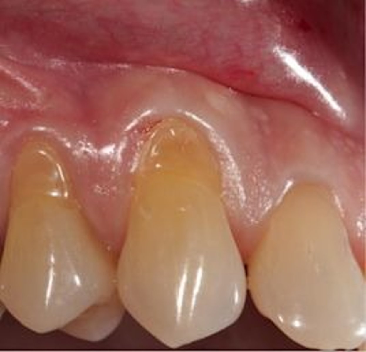 <p>Loss of tooth structure due to mechanical forces (toothbrushing):</p>