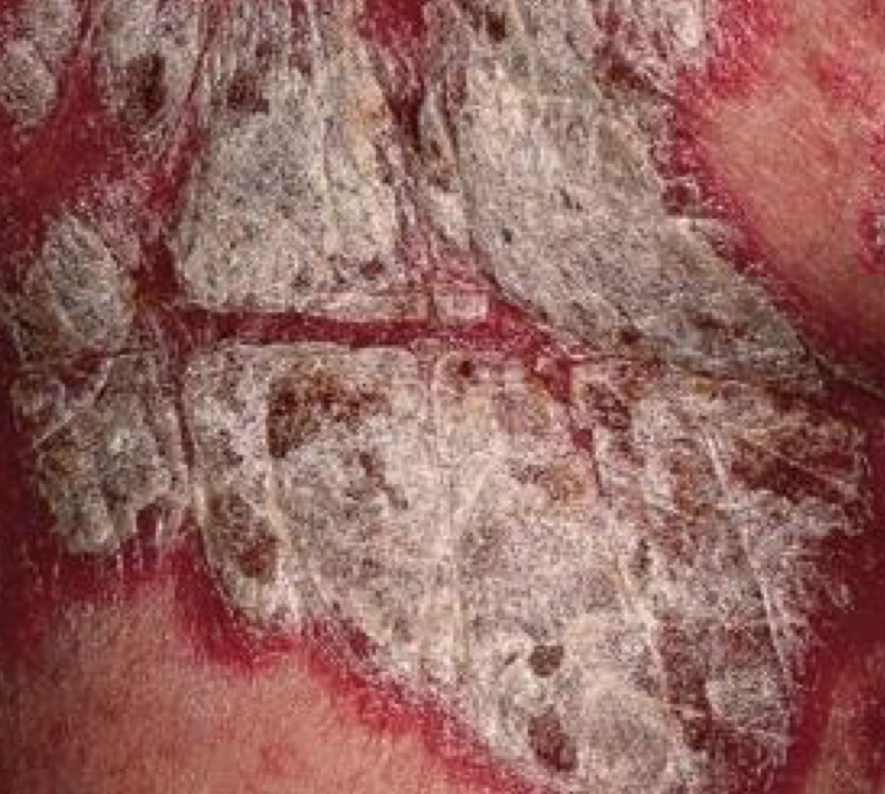 <p>what type of lesion and what condition is depicted</p>