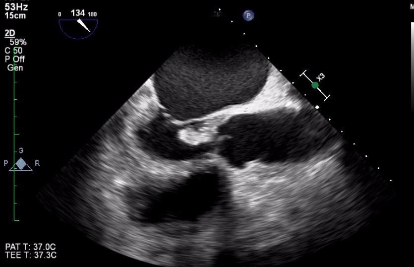 <p><span><span>What cardiac pathology does this represent?</span></span></p><p>Aortic valve vegetations</p><p>Thickened /calcified aortic valve</p><p>Thrombus</p><p>Fibroelastoma</p>